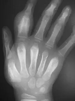 radiograph showing the same hand with thickened bones
