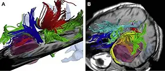 Intraoperative colocalization using iMRI images and 3-D Slicer software.