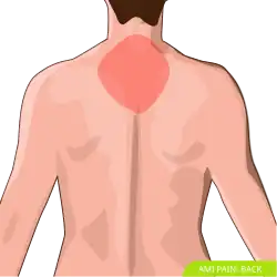 View of the back with common areas of MI coloured