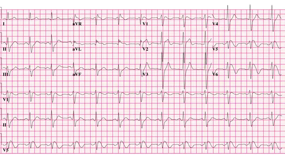 Type 1 Brugada ECG pattern (note non-standard lead position, V5 is placed one intercostal space above V1 and V6 is placed one intercostal space above V2)..