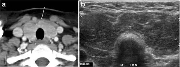 Fig. 15. A 33-year-old female patient who presented with neck swelling and pain and was later diagnosed with Hashimoto's thyroiditis. an Axial enhanced CT scan of the neck demonstrates minimal diffuse enlargement of the thyroid gland, especially the isthmus (white arrow). b Transverse greyscale ultrasound of the neck demonstrates heterogeneously enlarged thyroid and thickened isthmus, measuring 8.6&nbsp;mm.[1]