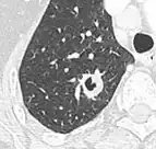 Cavitation with relatively thick wall, in this case aspergilloma).[9]