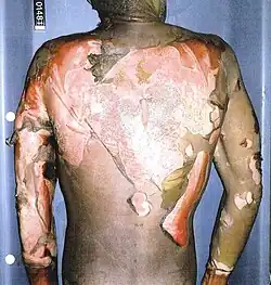 Autopsy photograph of Rainey's back.