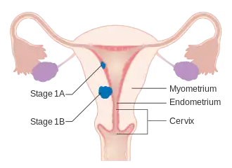 A diagram of stage IA and IB endometrial cancer