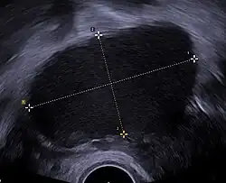 Transvaginal ultrasonography showing a 67 x 40&nbsp;mm endometrioma, with a somewhat grainy content.