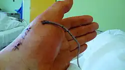 Hand with sutures and surgical drain
