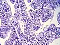 Histopathology of gallbladder carcinoma, with marked nuclear pleomorphism.