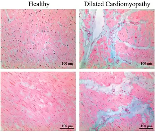 Healthy myocardium versus interstitial fibrosis in dilated cardiomyopathy. Alcian blue stain.