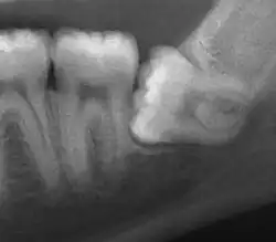 Impacted wisdom tooth with a horizontal orientation