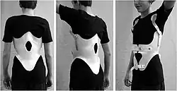 Modern brace for the treatment of a thoracic kyphosis. The brace is constructed using a CAD/CAM device.[17]