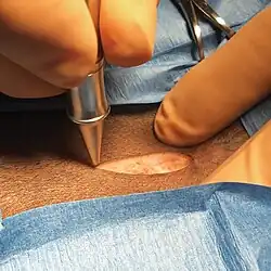 Close-up of gloved hands holding a LightScalpel carbon dioxide laser handpiece as it makes a precise, bloodless incision in a patient’s lower abdominal skin, with a blue sterile drape in view.