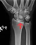 Dislocated lunate