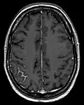 Meningeal carcinomatosis in a patient with breast cancer (contrast-enhanced axial T1-weighted MRI)