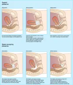 Images of pessaries of different shapes inserted into the vaginal canal