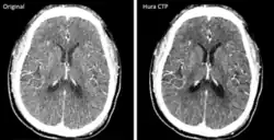 Original (left side) compared to reconstructed (right side) brain image produced from CT scans with low radiation dose. Reconstruction method improves image quality for accurate diagnosis.