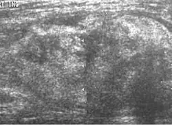 Fig. 5 Ultrasonography of a liposarcoma with high-echo areas reflected from its lipomatous matrix and low-echo areas reflected from its non-lipomatous areas.[69]