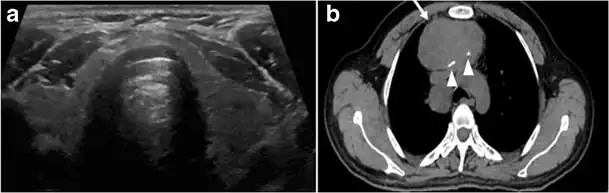 Fig. 4. A 45-year-old male patient presented with anterior mediastinal metastatic PTC lesions and occult primary on imaging. Histopathology examination of the resected thyroid gland revealed micro-foci of PTC; the largest, in the isthmus, measured 4&nbsp;mm. a transverse greyscale ultrasound of the thyroid demonstrates homogeneous gland with normal echogenicity and size. No focal lesion or micro-calcifications. b Non-enhanced CT scan obtained as part of PET/CT examination shows a heterogeneous, large, relatively dense anterior mediastinal mass (white arrow) with peripheral calcification (arrowheads). Thyroid gland has normal CT appearance with no abnormal FDG uptake (not shown).[1]